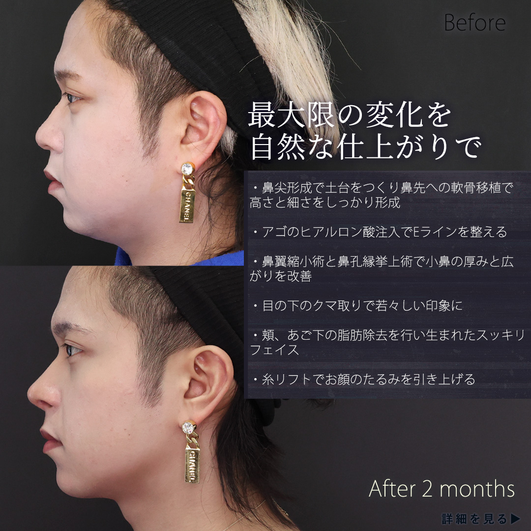 鼻尖形成・鼻尖縮小/バッカルファット除去/ジョールファット除去の症例写真 施術前後