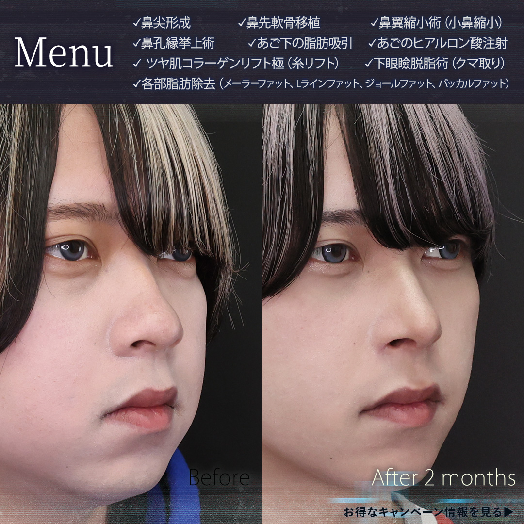 鼻尖形成・鼻尖縮小/バッカルファット除去/ジョールファット除去の症例写真 施術前後
