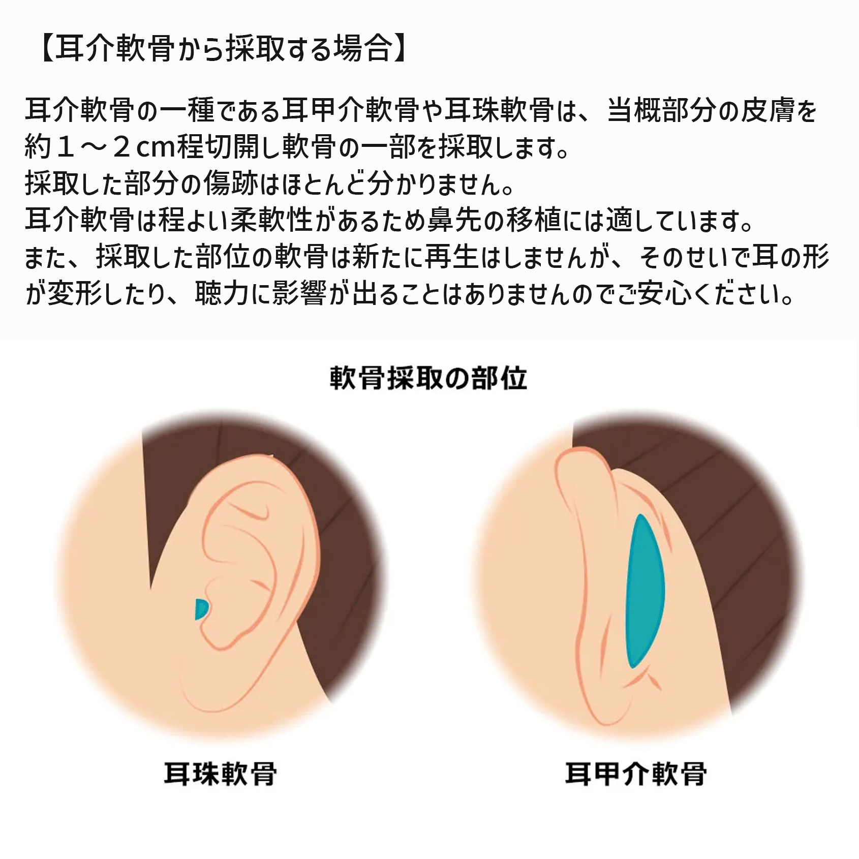 鼻尖形成・鼻尖縮小/バッカルファット除去/ジョールファット除去の症例写真 施術前後