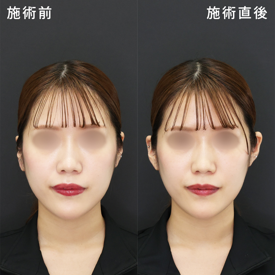 網紅(ワンホン)風の中顔面短縮術｜立ち耳ヒアルロン酸注射