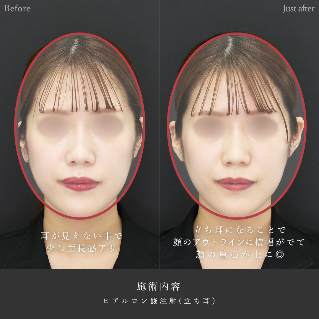 立ち耳の症例写真 施術前後 