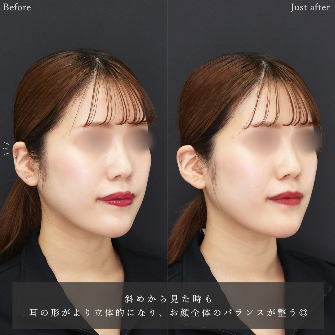 立ち耳の症例写真 施術前後 