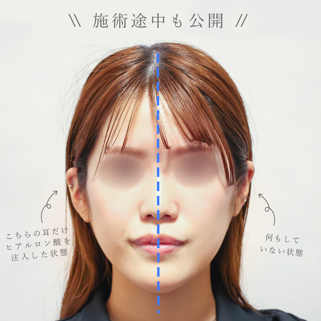 立ち耳の症例写真 施術前後 