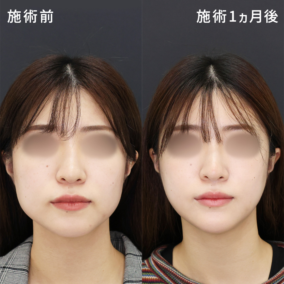口横のもたつきを無くし、自然な小顔に《脂肪吸引×糸リフト》