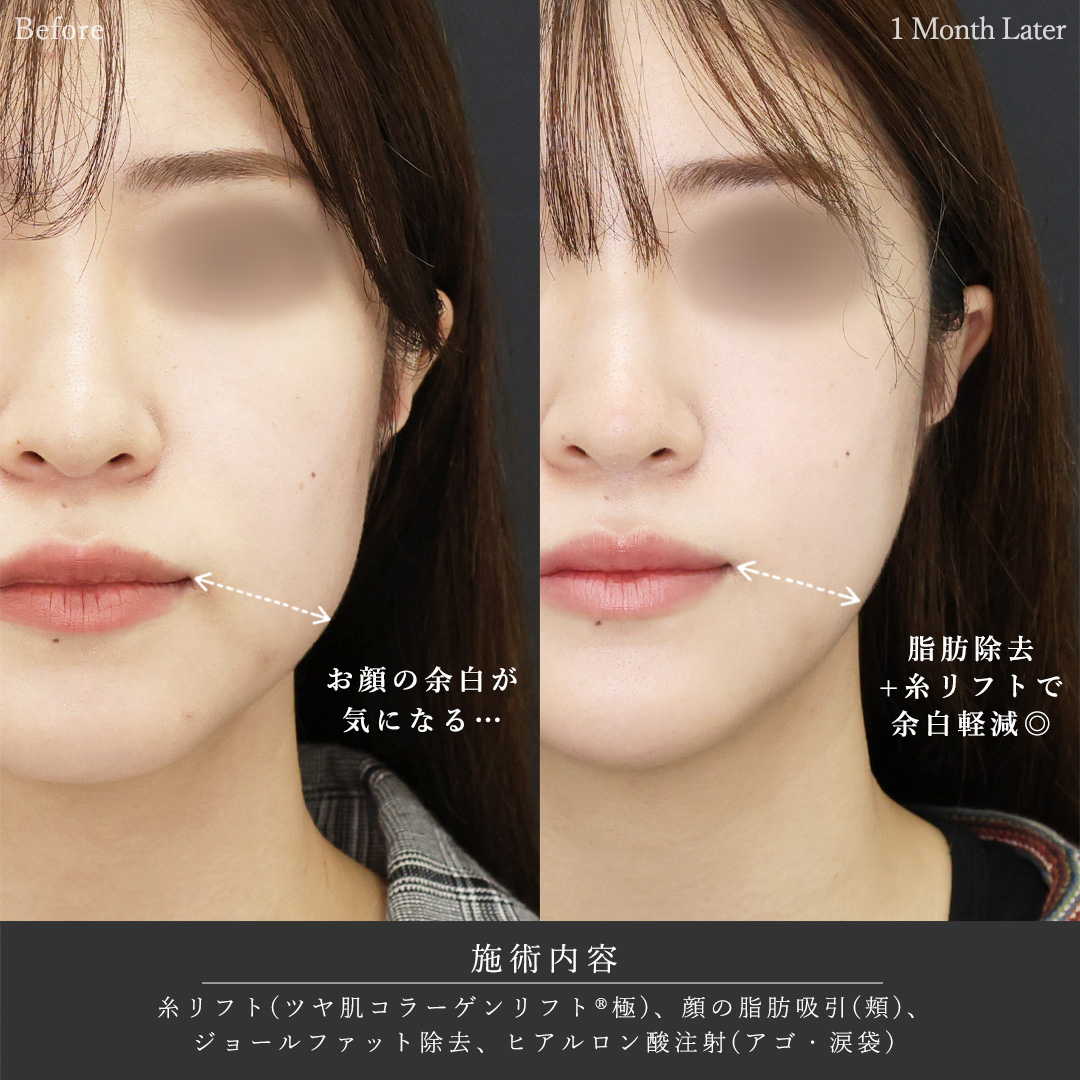 TAC式 ツヤ肌コラーゲンリフト®/ジョールファット除去/顔の脂肪吸引の症例写真 施術前後