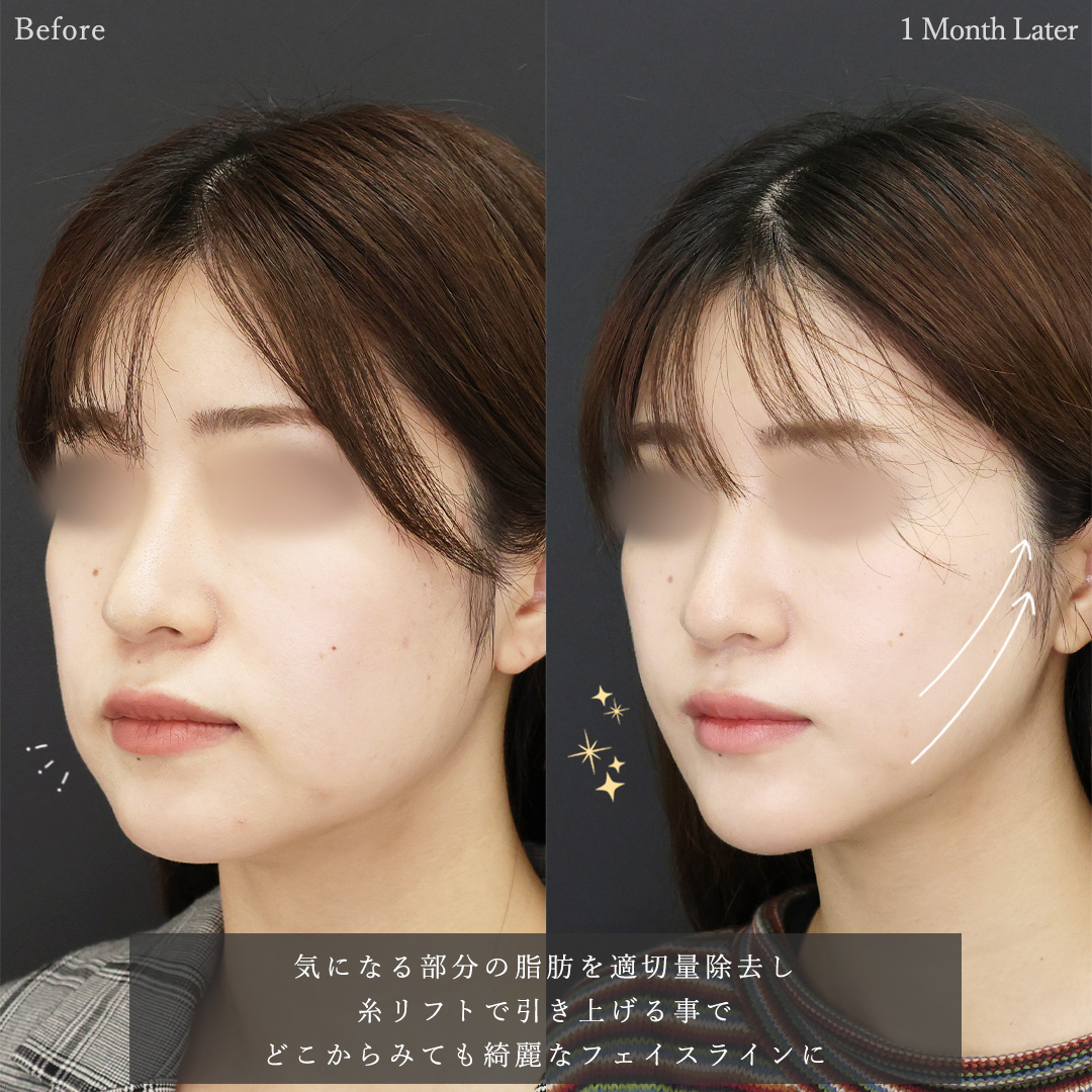 TAC式 ツヤ肌コラーゲンリフト®/ジョールファット除去/顔の脂肪吸引の症例写真 施術前後