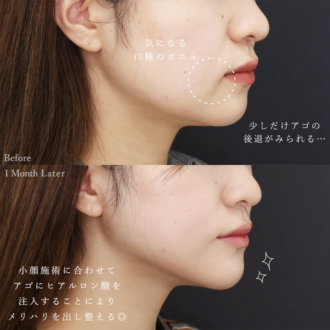 TAC式 ツヤ肌コラーゲンリフト®/ジョールファット除去/顔の脂肪吸引の症例写真 施術前後