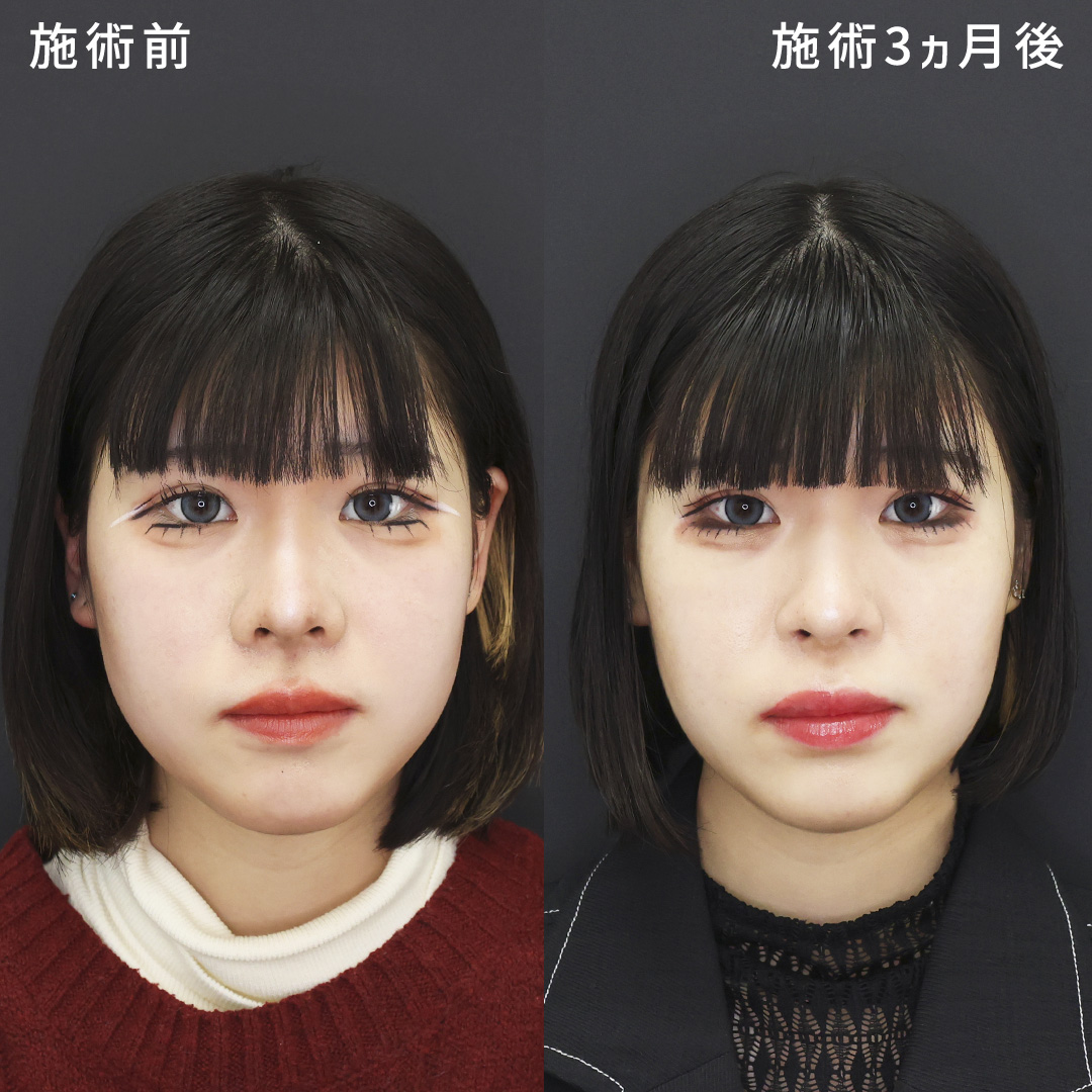 小鼻の印象を薄く《鼻翼縮小×鼻孔縁挙上術》