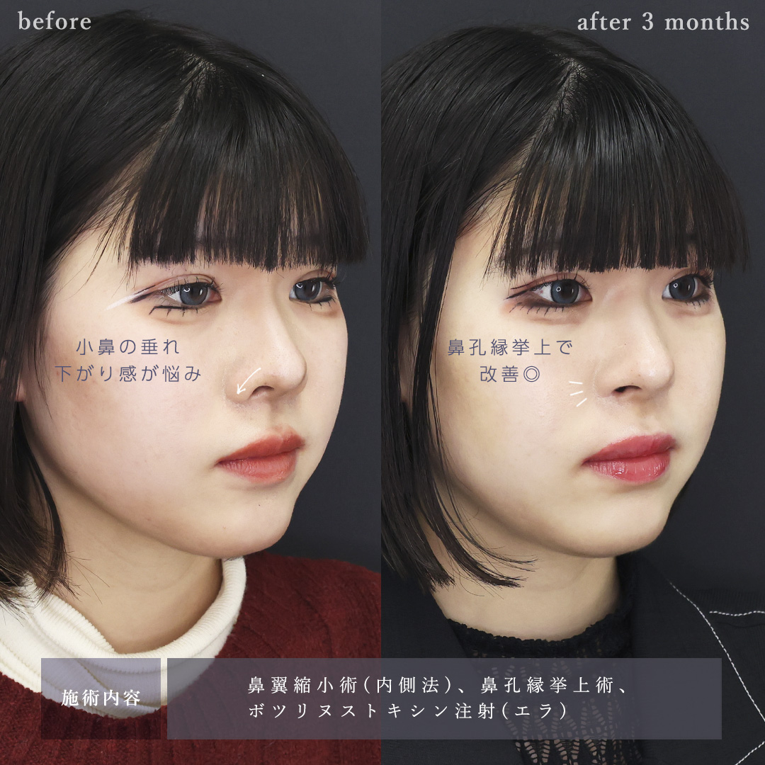 鼻孔縁挙上術/TAC式 鼻翼縮小術（小鼻縮小）/エラボトックス注射の症例写真 施術前後 