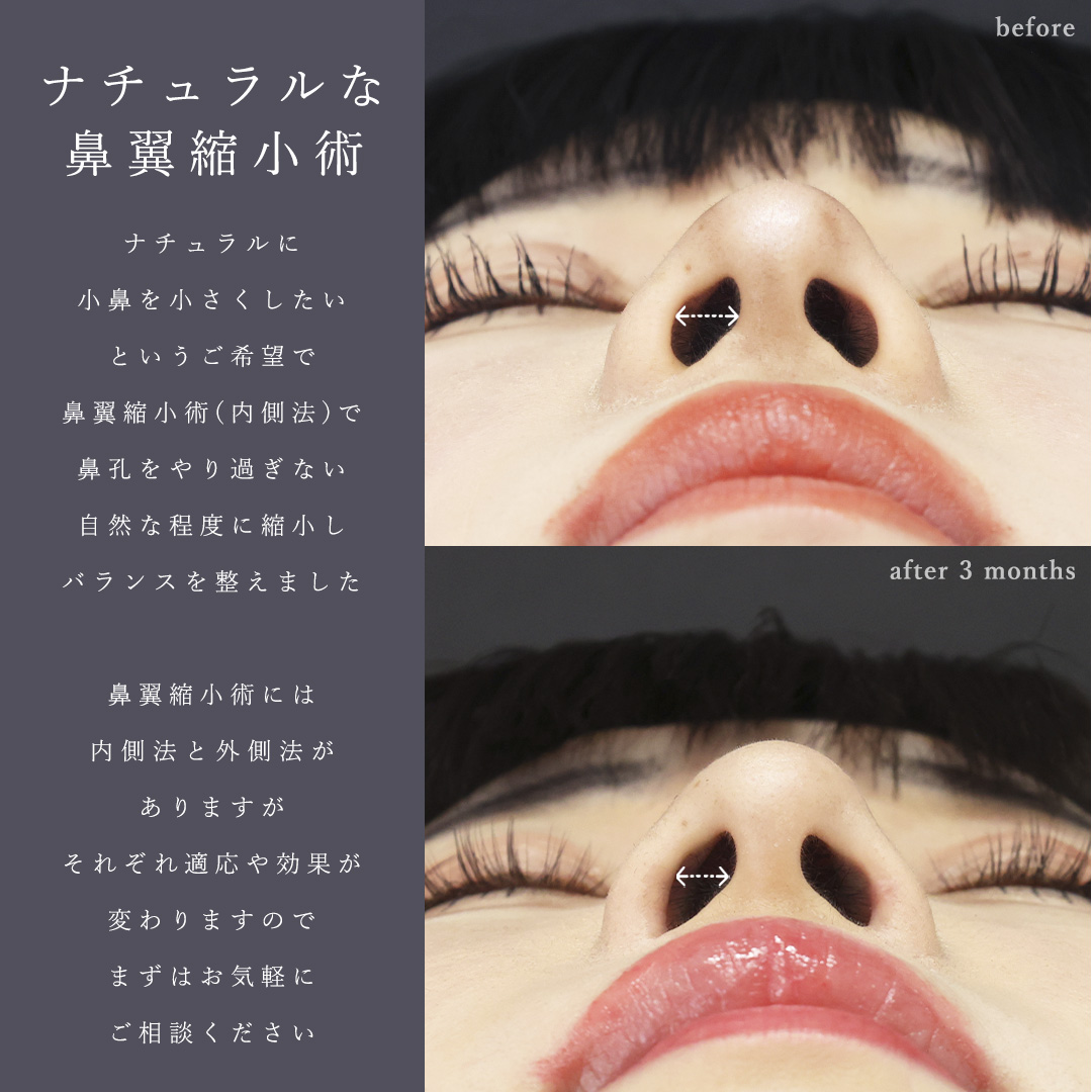 鼻孔縁挙上術/TAC式 鼻翼縮小術（小鼻縮小）/エラボトックス注射の症例写真 施術前後 