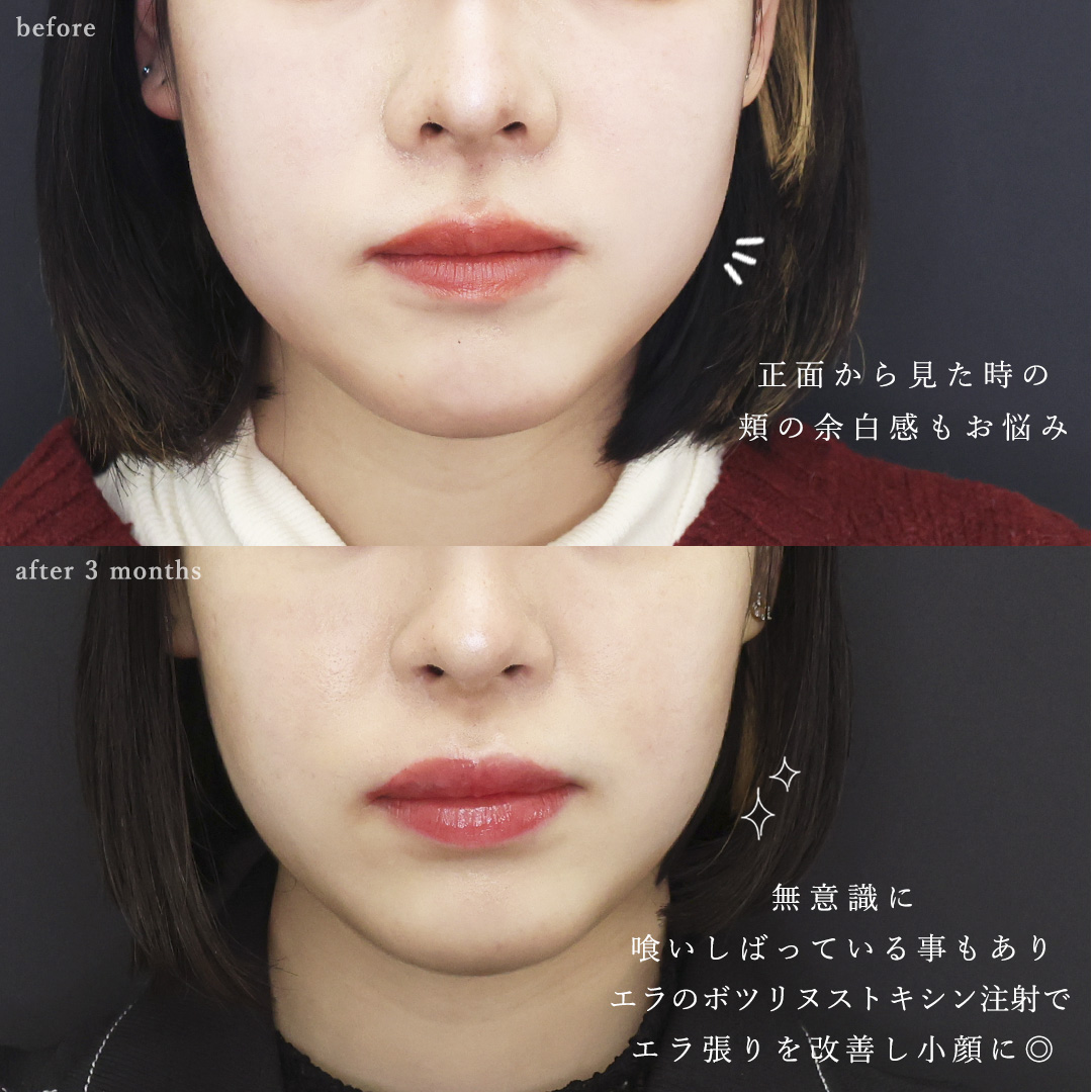 鼻孔縁挙上術/TAC式 鼻翼縮小術（小鼻縮小）/エラボトックス注射の症例写真 施術前後 