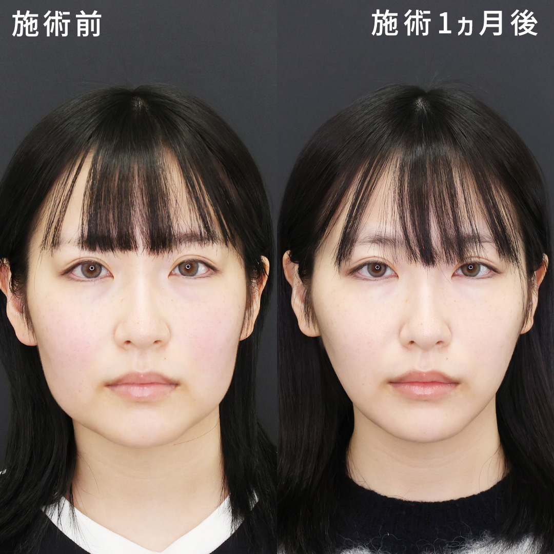【モデル級小顔術】輪郭のもたつきを無くし、自分史上一番の小顔に