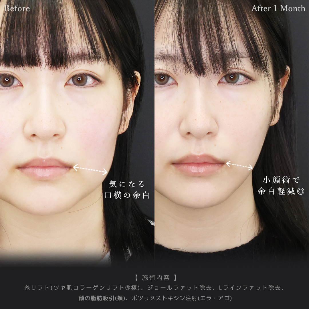 TAC式 ツヤ肌コラーゲンリフト®/ジョールファット除去/Lラインファット除去（エラ下脂肪除去）の症例写真 施術前後 