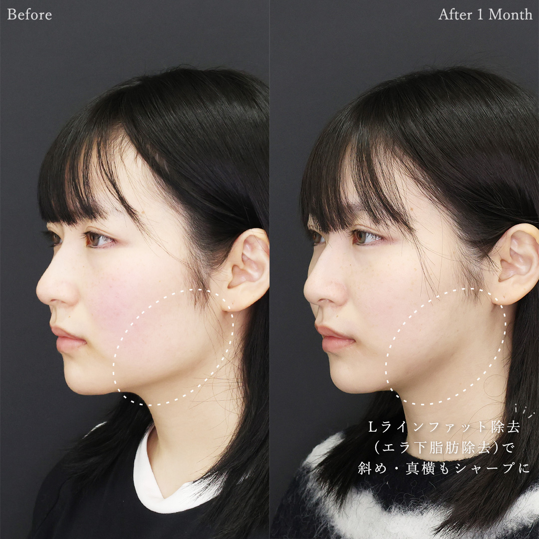 TAC式 ツヤ肌コラーゲンリフト®/ジョールファット除去/Lラインファット除去（エラ下脂肪除去）の症例写真 施術前後 