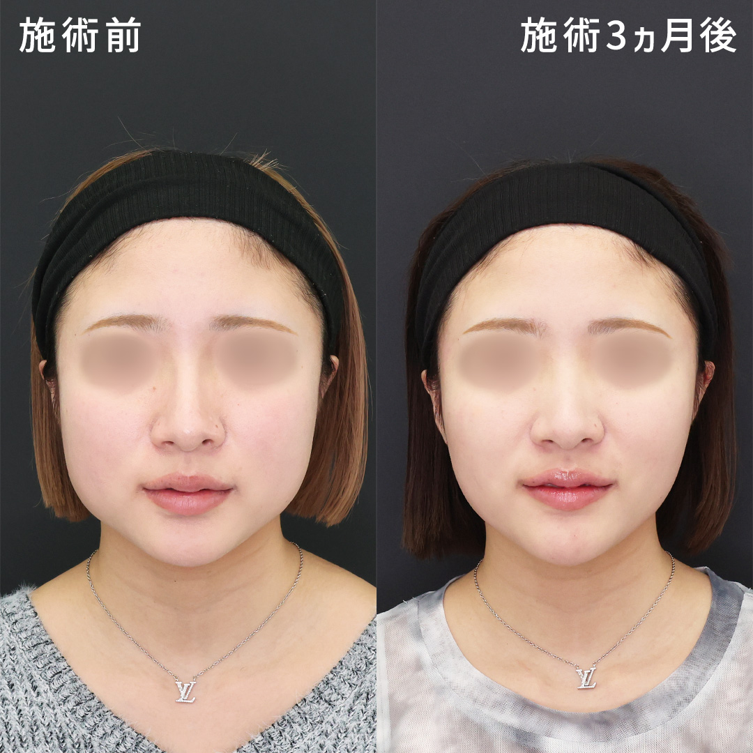 【下膨れ改善】笑った時のポコっと輪郭をスマートに｜形成外科専門医が行う小顔術