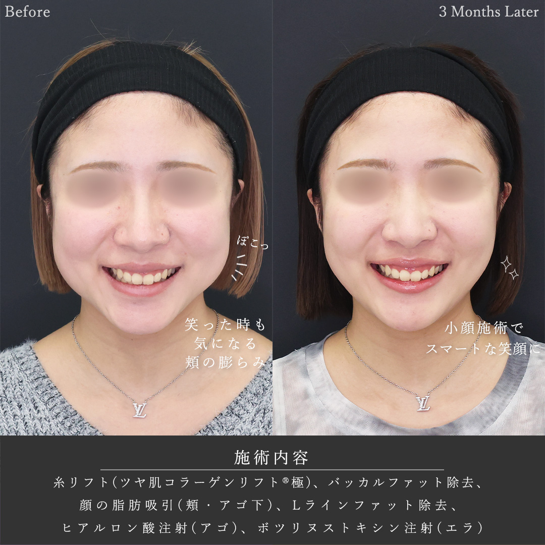 TAC式 ツヤ肌コラーゲンリフト®/バッカルファット除去/顔の脂肪吸引の症例写真 施術前後 