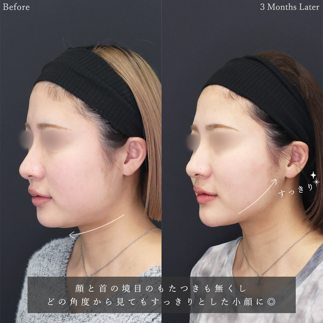 TAC式 ツヤ肌コラーゲンリフト®/バッカルファット除去/顔の脂肪吸引の症例写真 施術前後 