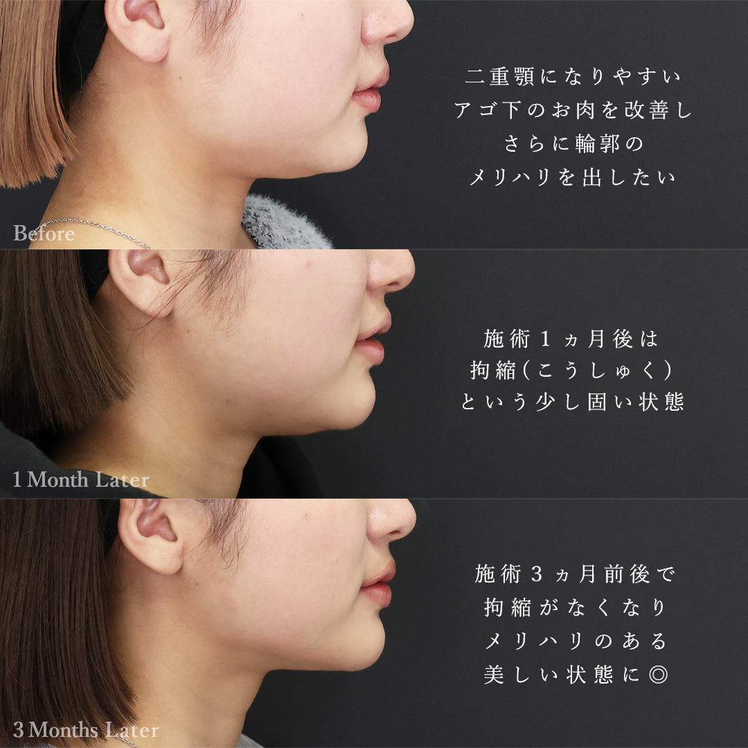 TAC式 ツヤ肌コラーゲンリフト®/バッカルファット除去/顔の脂肪吸引の症例写真 施術前後 