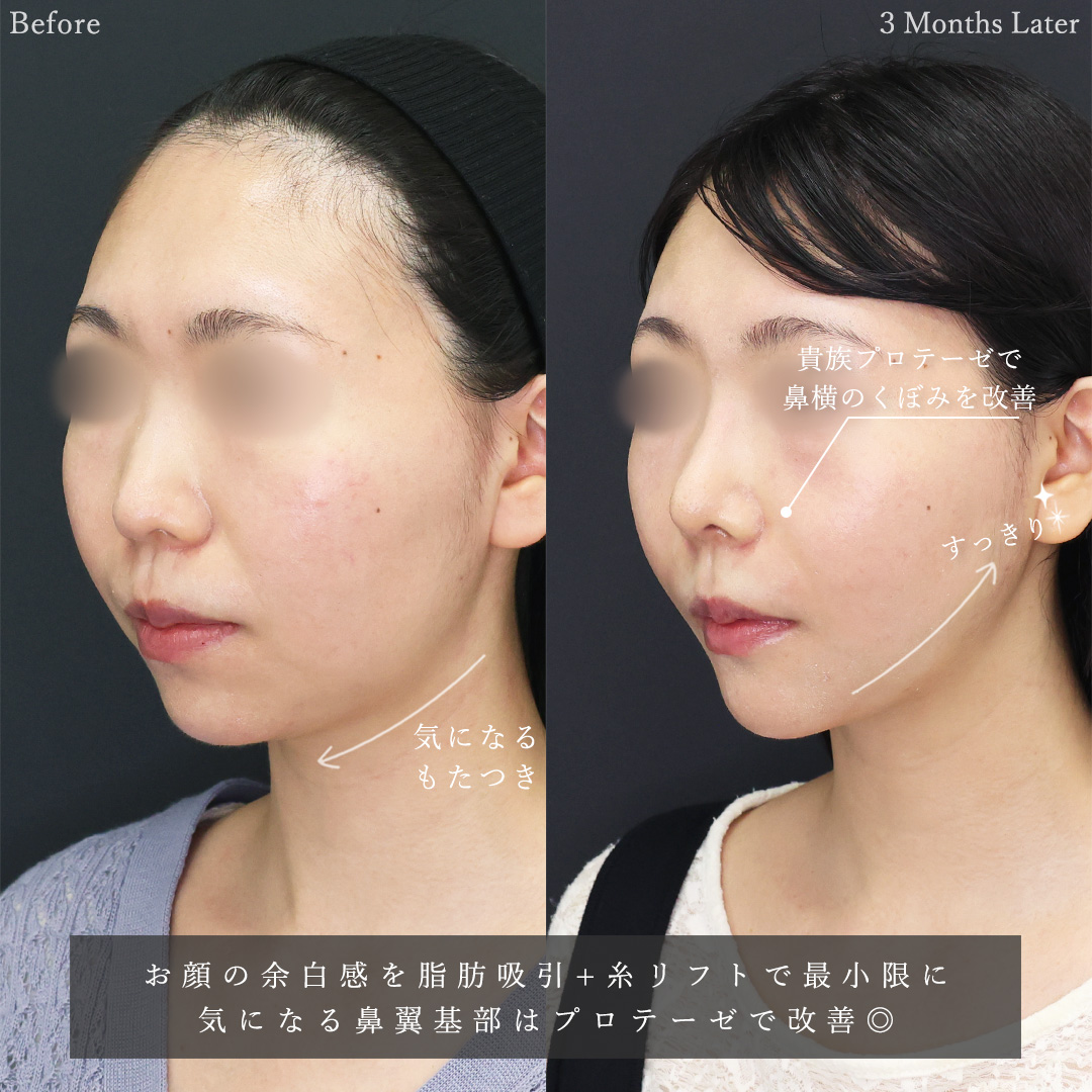 TAC式 ツヤ肌コラーゲンリフト®/ジョールファット除去/顔の脂肪吸引の症例写真 施術前後 