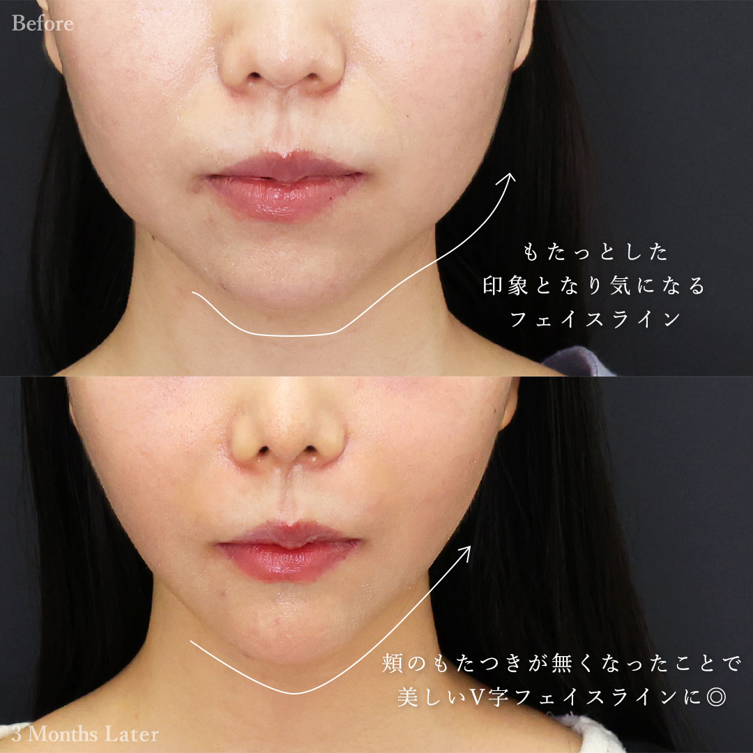 TAC式 ツヤ肌コラーゲンリフト®/ジョールファット除去/顔の脂肪吸引の症例写真 施術前後 