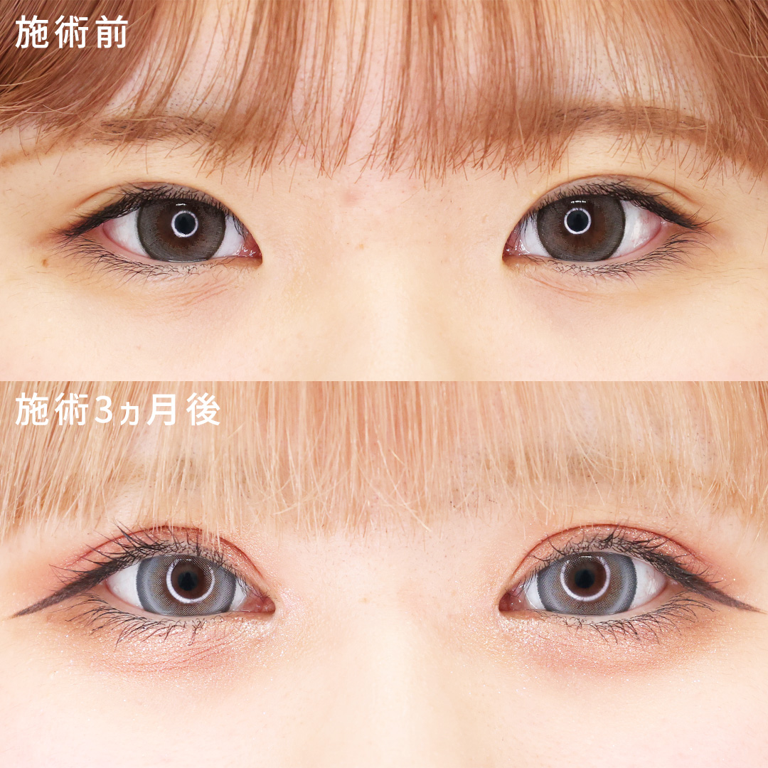 【途中経過写真アリ】目頭切開×埋没でぱっちり印象的な目元に