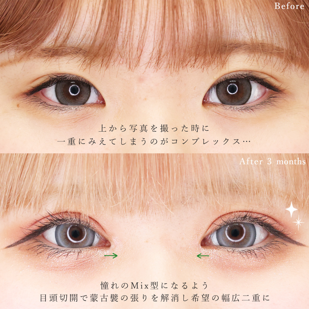 目頭切開術/二重埋没法の症例写真 施術前後 