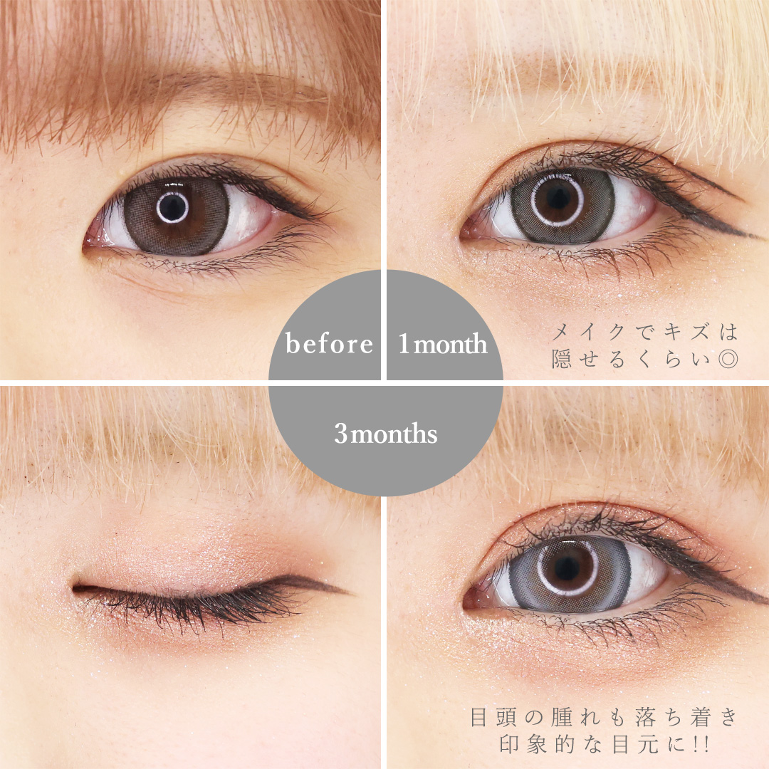 目頭切開術/二重埋没法の症例写真 施術前後 