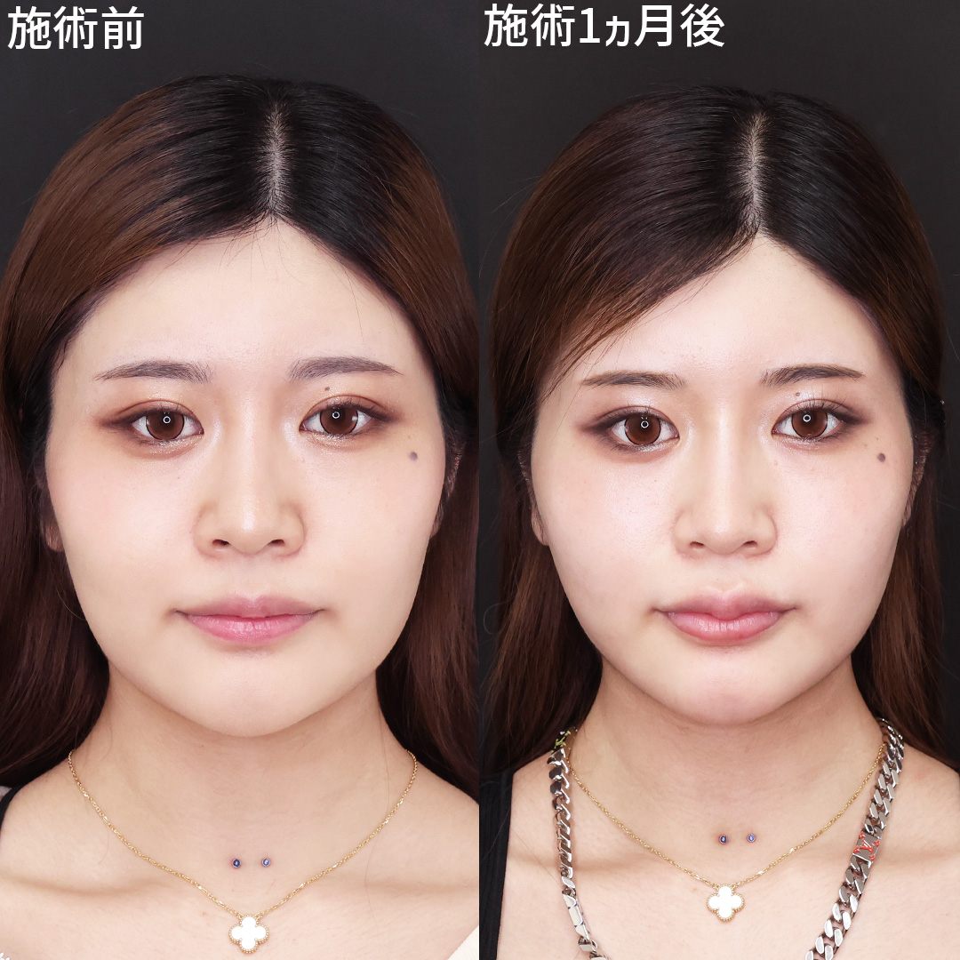 TAC式 ツヤ肌コラーゲンリフト®/Lラインファット除去（エラ下脂肪除去）/顔の脂肪吸引の症例写真 施術前後 