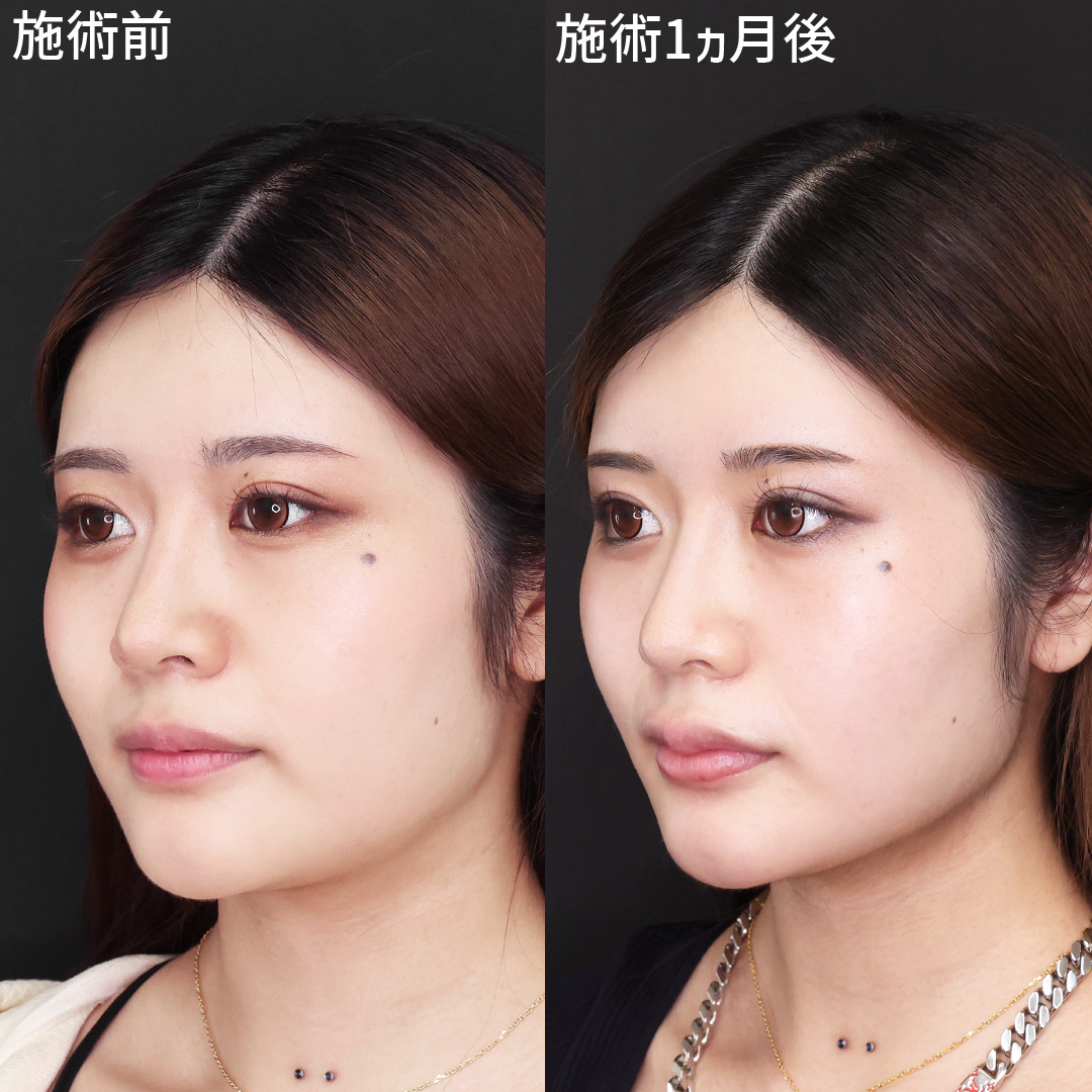 更に綺麗になる小顔術【脂肪吸引】で輪郭洗練