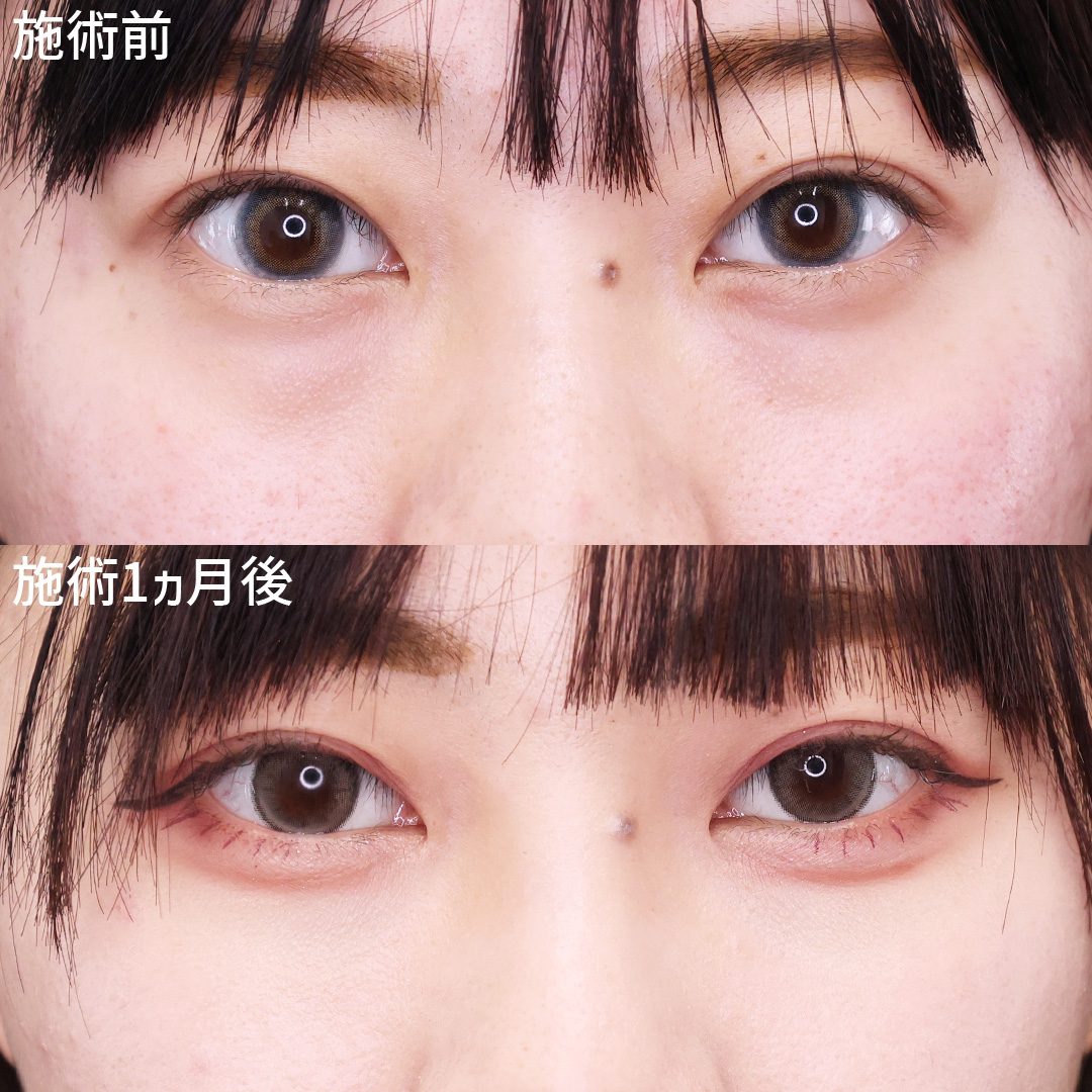 【クマ取り】で明るい目元に！第一印象もUP