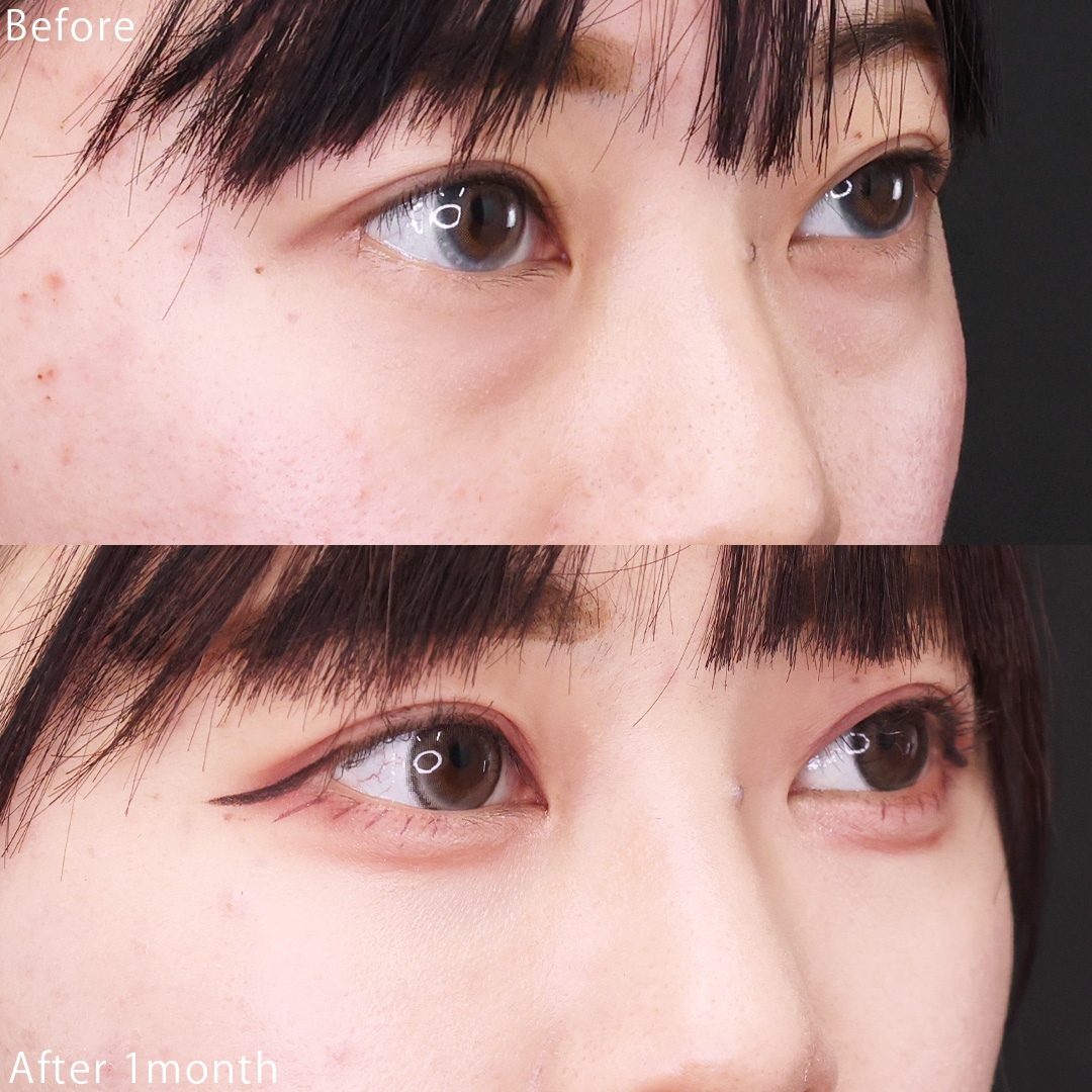 下眼瞼脱脂術（目の下のたるみ取り・目の下の脂肪ふくらみ取り）/目の下のヒアルロン酸注射の症例写真 施術前後 