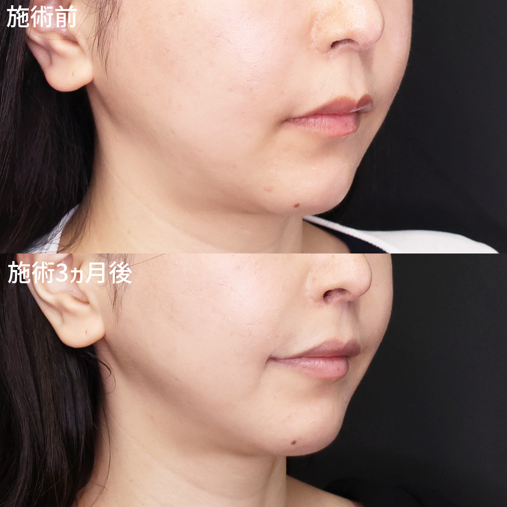 更に上品なお顔立ちへ、ナチュラルに洗練