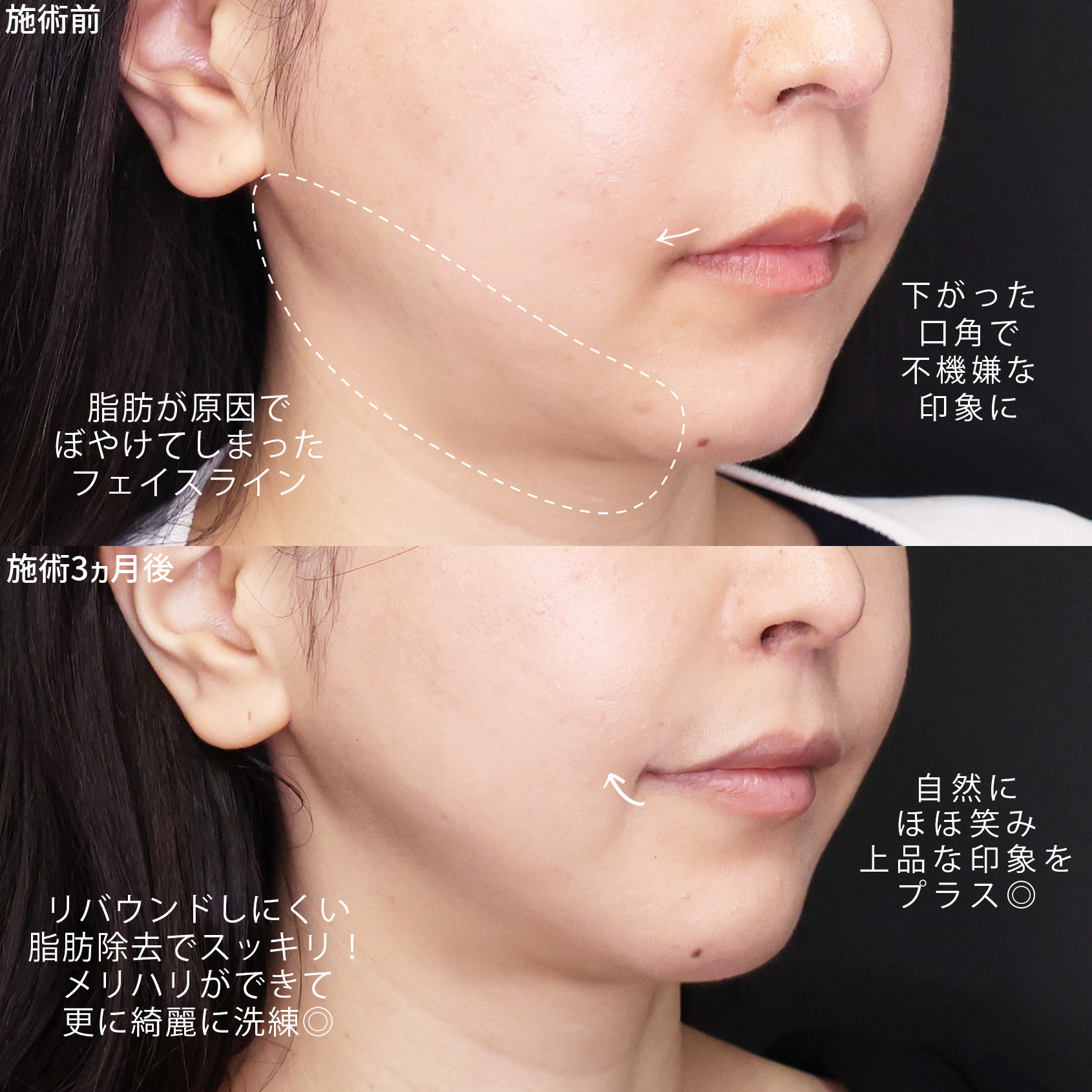 口角挙上・リフト（マイクロ切開法・内側法/口内法）/TAC式 ツヤ肌コラーゲンリフト®/Lラインファット除去（エラ下脂肪除去）の症例写真 施術前後 