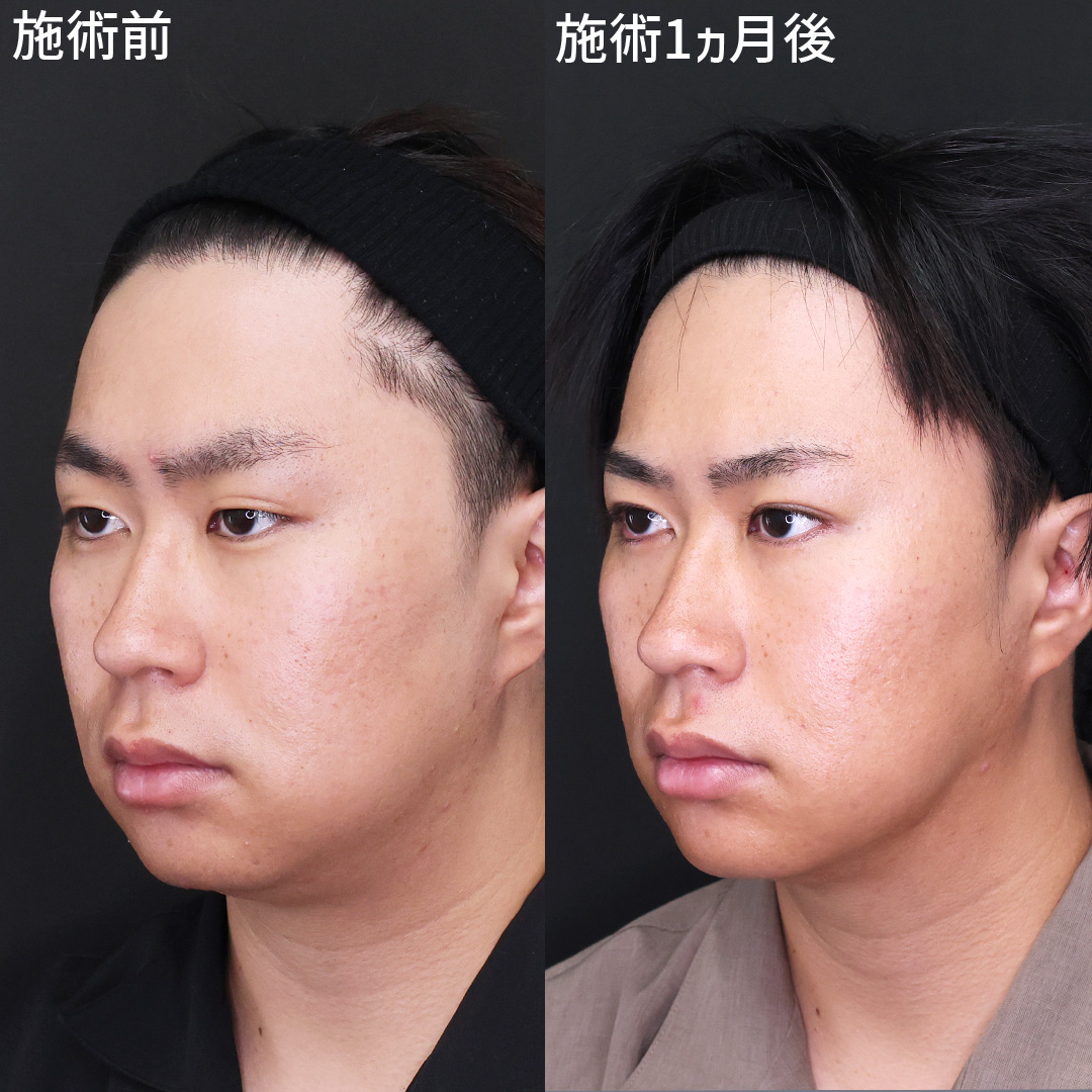 【顔の脂肪吸引】でムダ肉を解消◎すっきりイケメンに