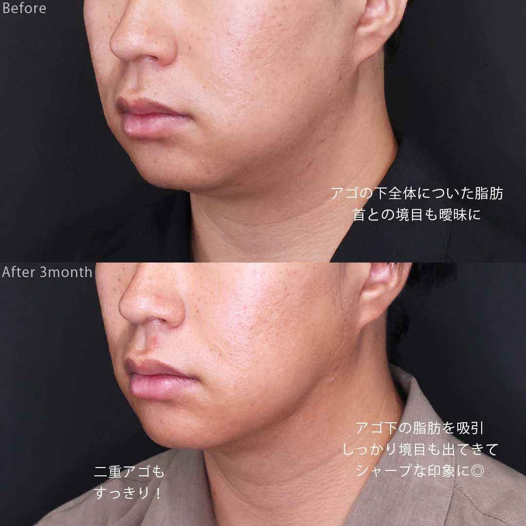 ジョールファット除去/Lラインファット除去（エラ下脂肪除去）/顎下の脂肪吸引の症例写真 施術前後 