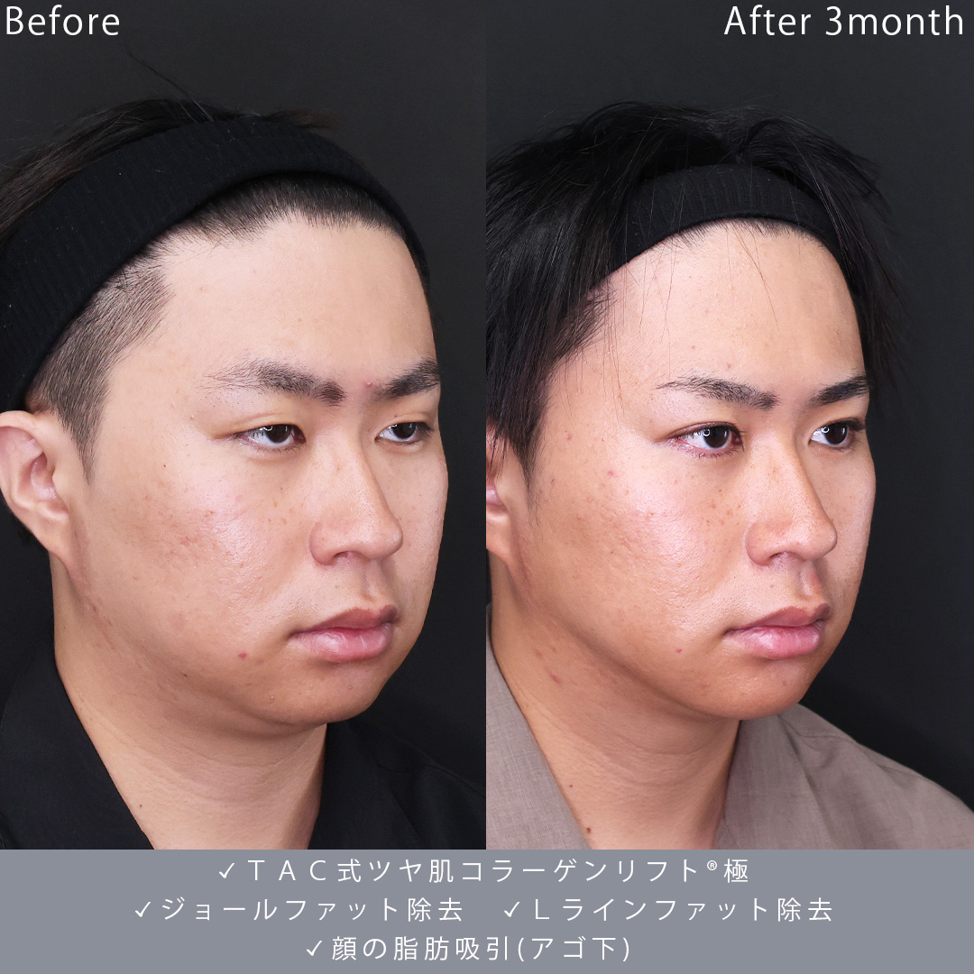 ジョールファット除去/Lラインファット除去（エラ下脂肪除去）/顎下の脂肪吸引の症例写真 施術前後 