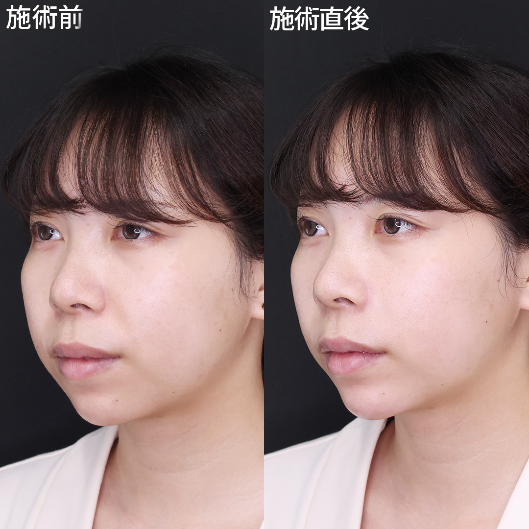 小鼻横の【ヒアルロン酸注射】で疲れ顔を改善！