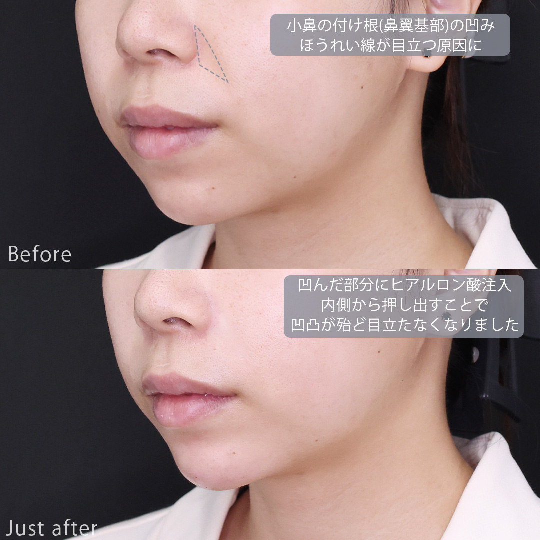 顎のヒアルロン酸注射/ヒアルロン酸注射：その他の症例写真 施術前後 