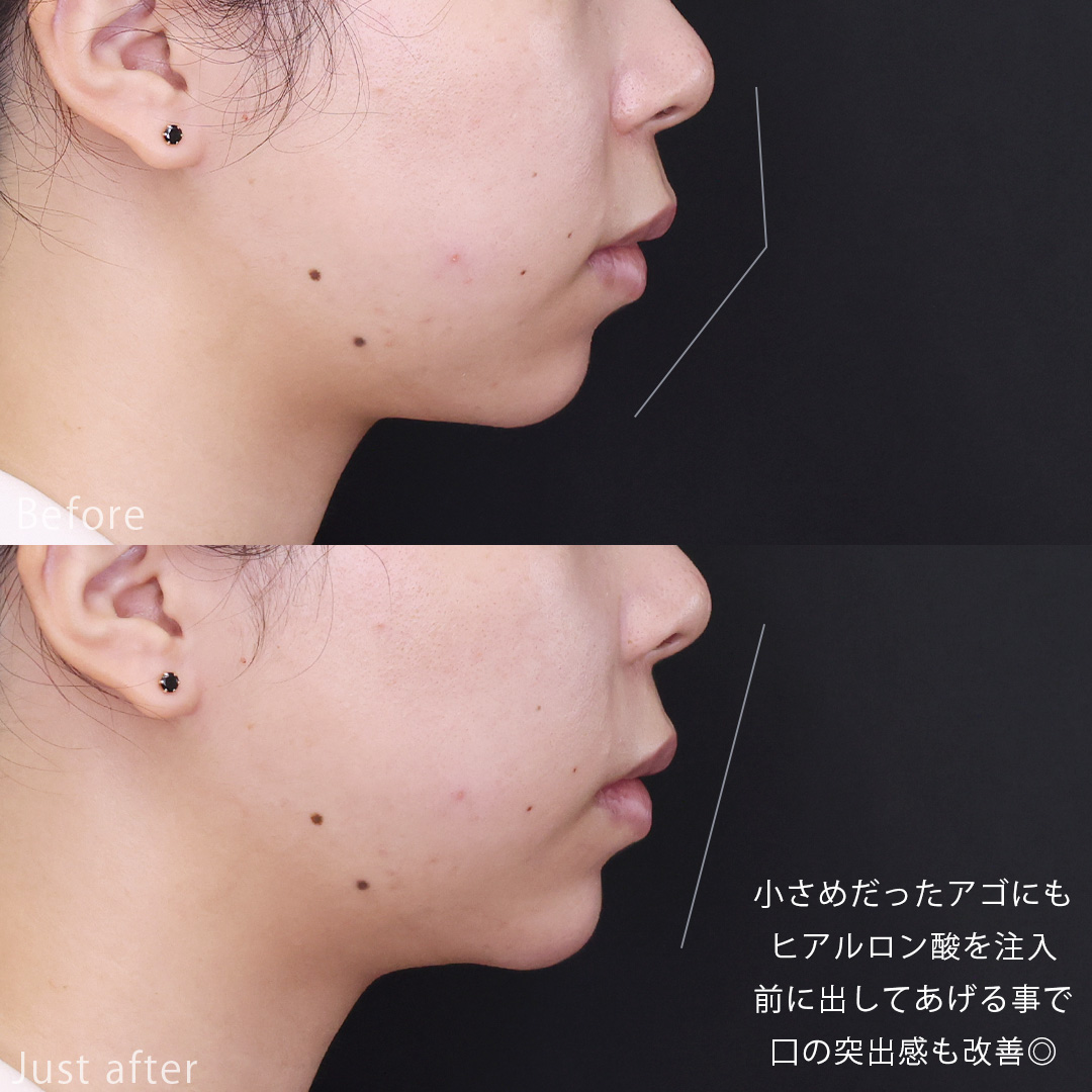 顎のヒアルロン酸注射/ヒアルロン酸注射：その他の症例写真 施術前後 
