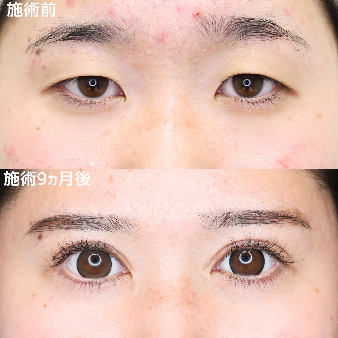 《目元フル整形》ほんとに同一人物⁉可愛くなりすぎて人生180度変わりました