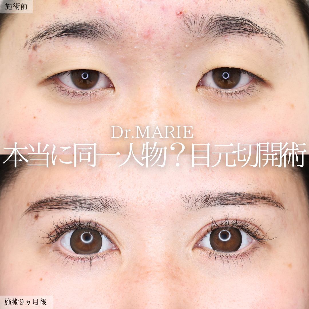 二重切開（全切開法）/眼瞼下垂（目つき矯正）/グラマラスライン（タレ目形成）の症例写真 施術前後 
