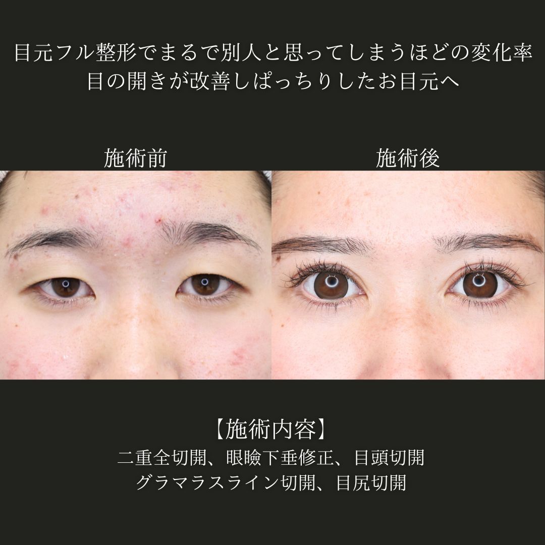 二重切開（全切開法）/眼瞼下垂（目つき矯正）/グラマラスライン（タレ目形成）の症例写真 施術前後 