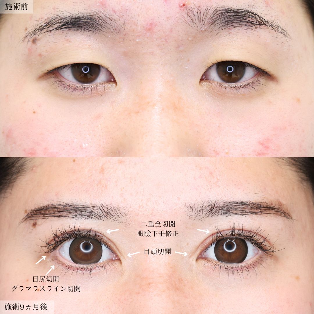 二重切開（全切開法）/眼瞼下垂（目つき矯正）/グラマラスライン（タレ目形成）の症例写真 施術前後 