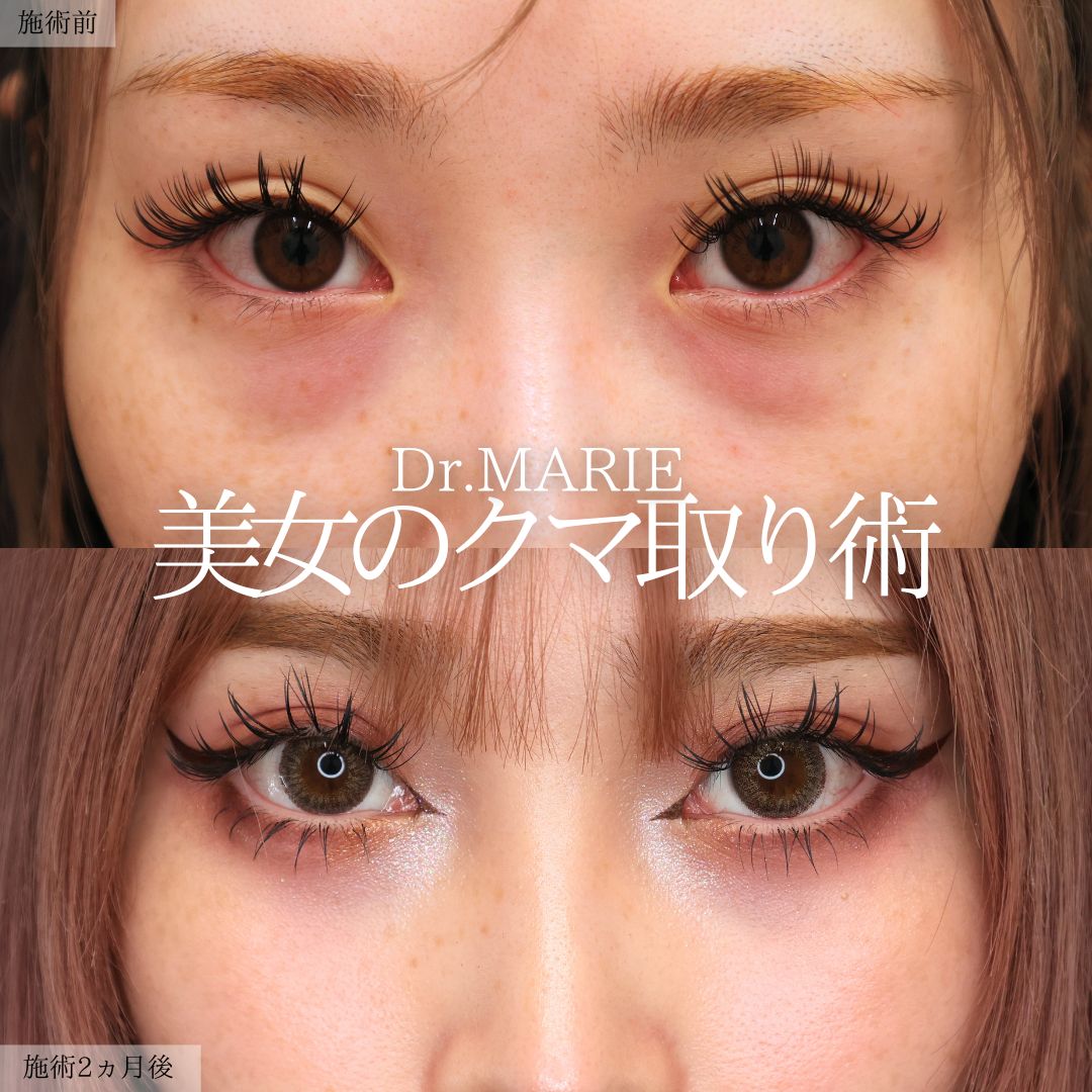 下眼瞼脱脂術(目の下のたるみ取り・目の下の脂肪ふくらみ取り)の症例写真 施術前後