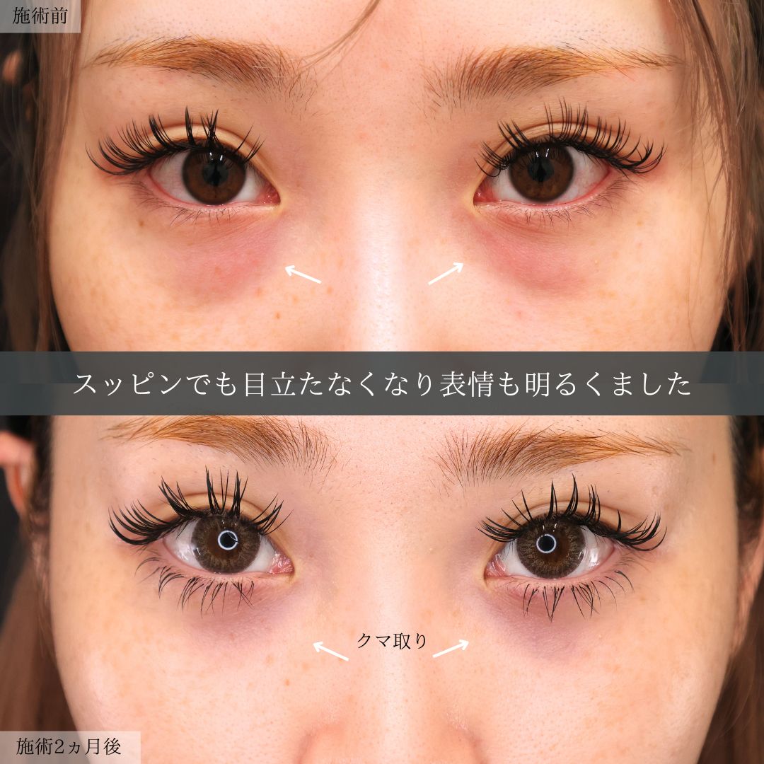 下眼瞼脱脂術(目の下のたるみ取り・目の下の脂肪ふくらみ取り)の症例写真 施術前後