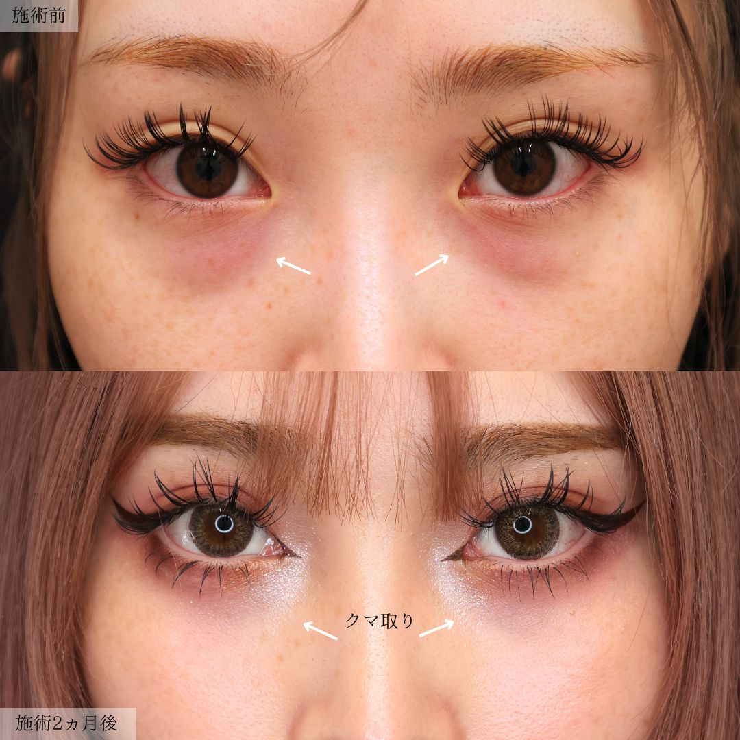 下眼瞼脱脂術(目の下のたるみ取り・目の下の脂肪ふくらみ取り)の症例写真 施術前後