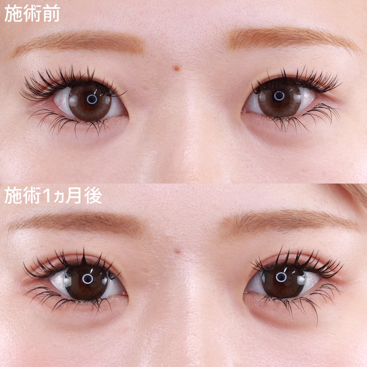 上眼瞼切開術の症例写真 施術前後