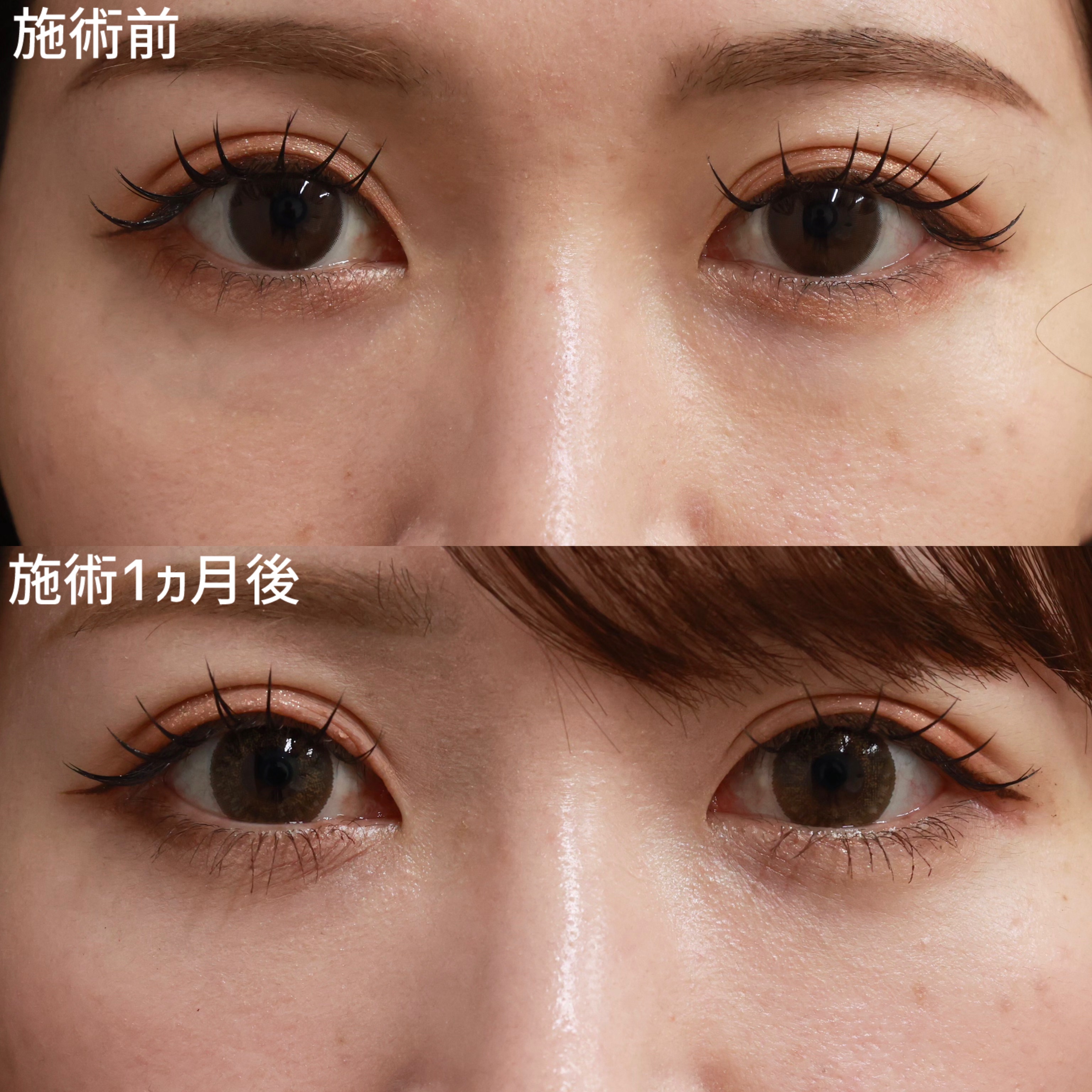 下眼瞼脱脂術(目の下のたるみ取り・目の下の脂肪ふくらみ取り)の症例写真 施術前後