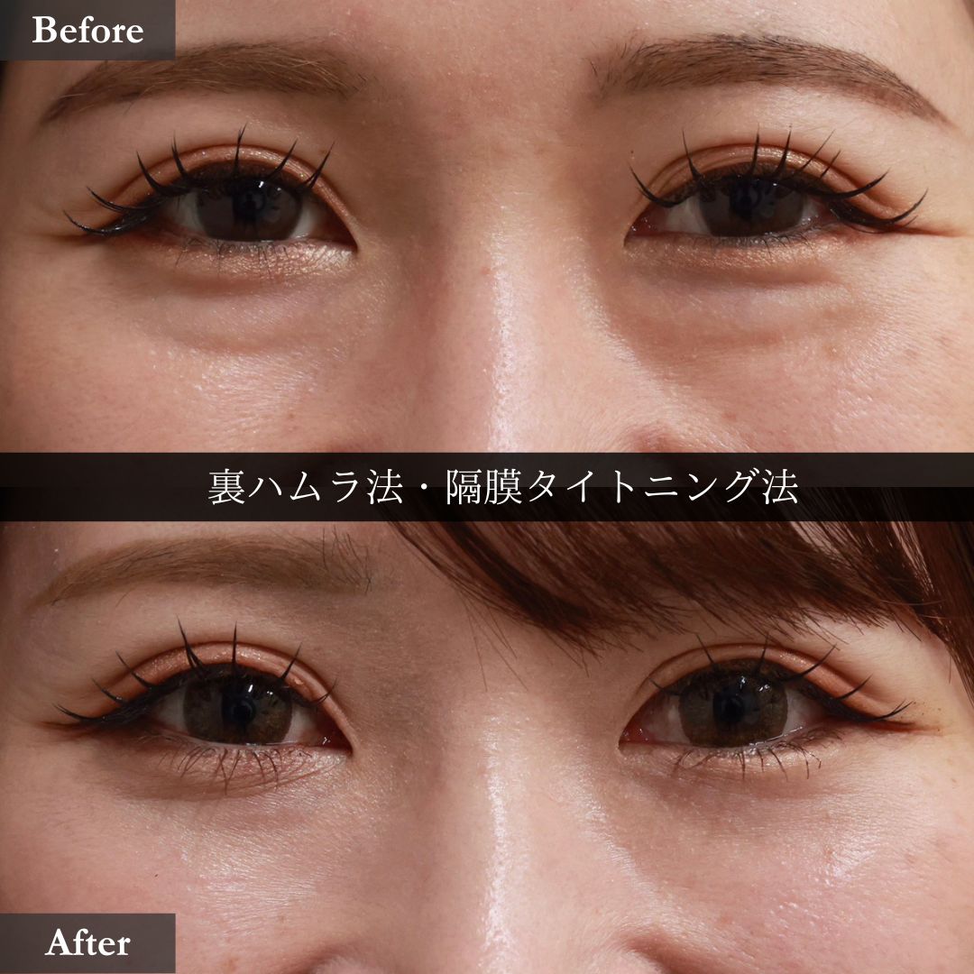 下眼瞼脱脂術(目の下のたるみ取り・目の下の脂肪ふくらみ取り)の症例写真 施術前後