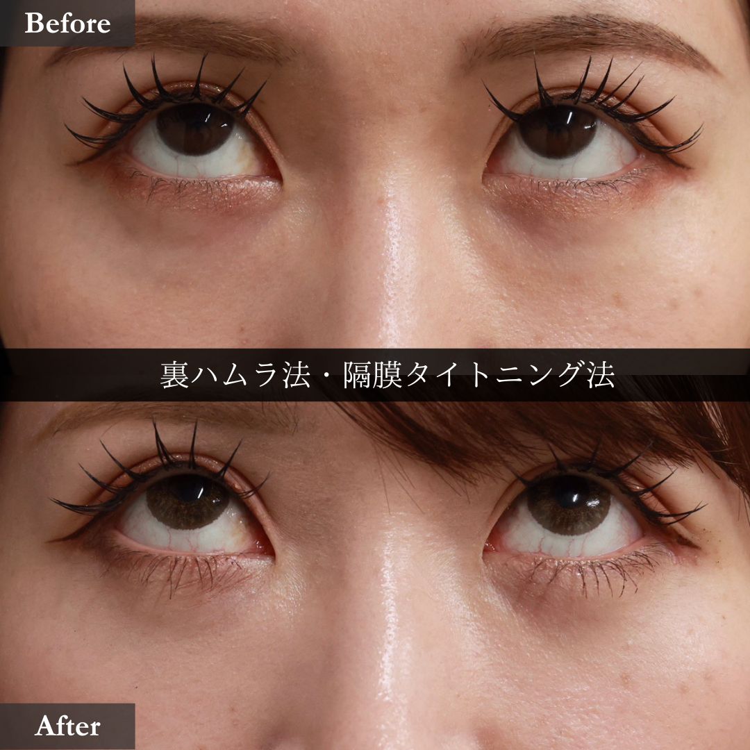 下眼瞼脱脂術(目の下のたるみ取り・目の下の脂肪ふくらみ取り)の症例写真 施術前後